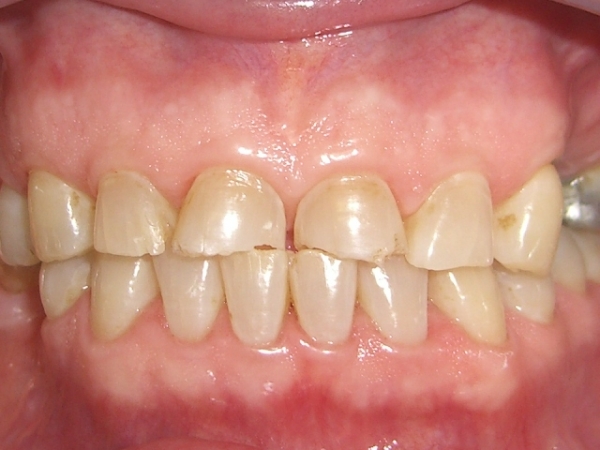 Apertamento-Dentário-1.jpg